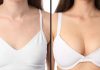 Cost of Breast Augmentation in Dubai