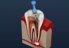 Beyond Expectations: Experience the Best Root Canal Treatment